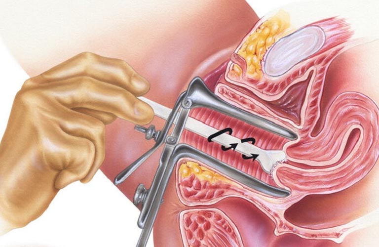 Bác sĩ sẽ lấy dịch âm đạo để mang đi xét nghiệm