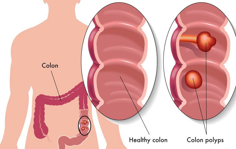 Polyp đại tràng là khối u xuất hiện ở niêm mạc đại tràng