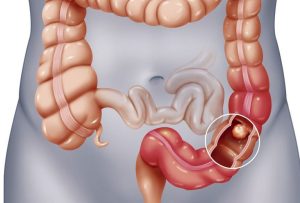 Polyp Đại Tràng: Nguyên Nhân, Cách Điều Trị, Phòng Ngừa