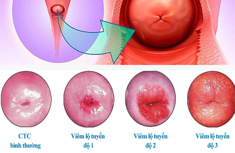 Hình ảnh viêm lộ tuyến