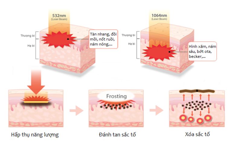 tri-nam-chan-sau-bang-laser (2)