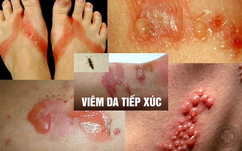 Hình ảnh viêm da tiếp xúc