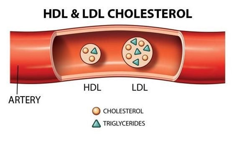 Triglycerides cao là tình trạng nồng độ triglycerides trong máu vượt mức bình thường