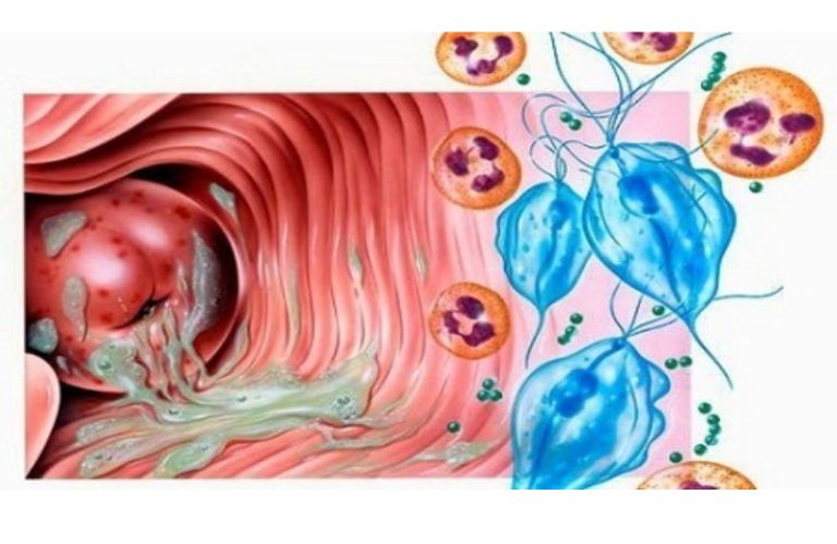 viem-am-dao-do-Trichomonas (1)