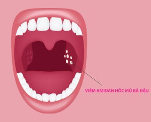 Viêm Amidan Hốc Mủ Bã Đậu