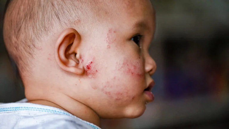 Có rất nhiều nguyên nhân khiến trẻ nhỏ bị viêm da cơ địa
