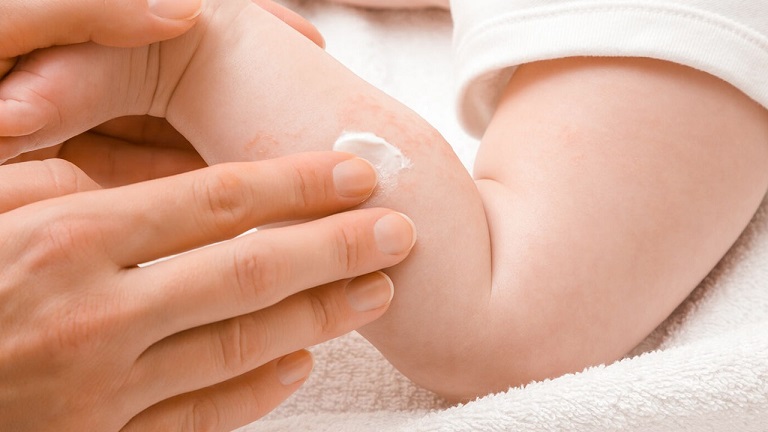 Sử dụng kem dưỡng ẩm giúp cải thiện ngứa ngáy khô da