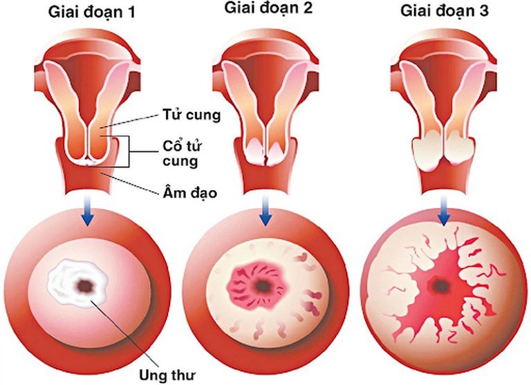 Viêm lộ tuyến 1cm là tình trạng viêm nhiễm xảy ra tại vùng lộ tuyến của cổ tử cung