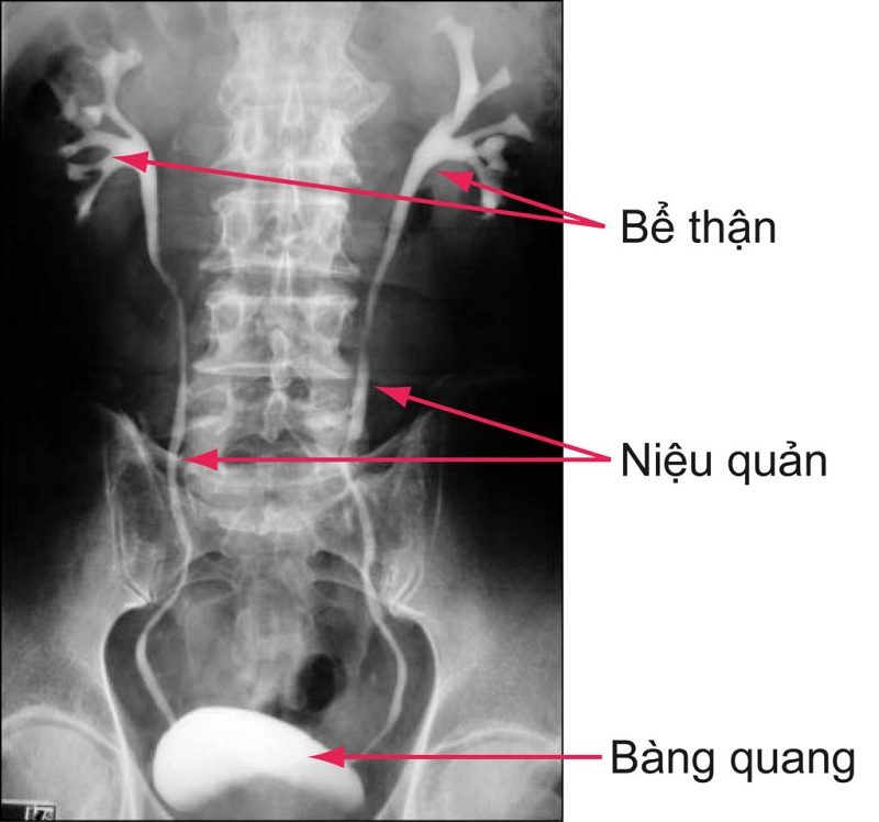 Kỹ thuật này chủ yếu phát hiện các loại sỏi calci oxalat và sỏi calci phosphat