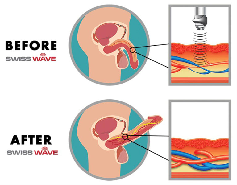 điều trị rối loạn cương dương bằng sóng xung kích