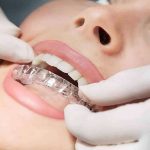 Niềng Răng Invisalign Là Gì? Ưu Nhược Điểm, Quy Trình Thực Hiện