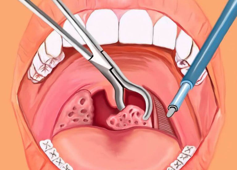 Phẫu thuật cắt bỏ amidan có chữa khỏi bệnh viêm họng không?