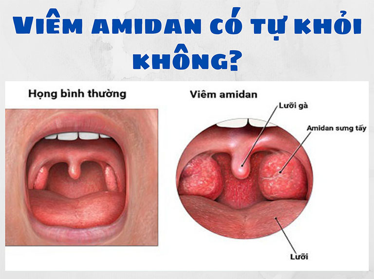 Viêm amidan có tự khỏi không?