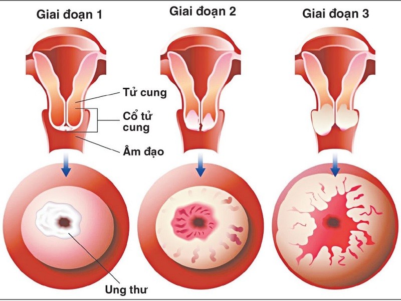 Hiểu đúng về mức độ nguy hiểm và các biến chứng đi cùng sẽ là tiền đề quan trọng trong điều trị hiệu quả căn bệnh này