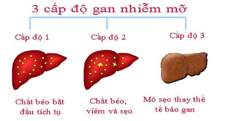 Gan nhiễm mỡ độ 2 là tình trạng mỡ tích tụ trong gan chiếm khoảng 33% đến 66% tổng lượng gan