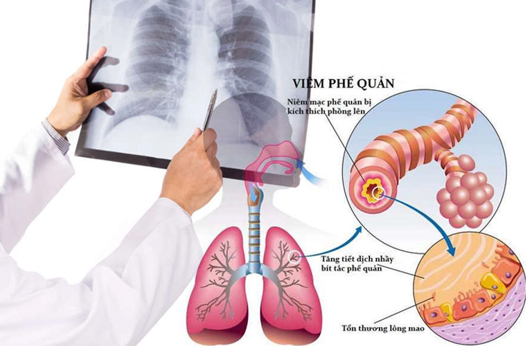 Viêm phế quản phổi ở người lớn khá phổ biến