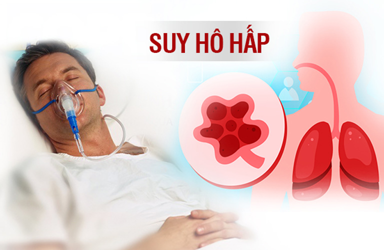 Viêm phế quản phổi có thể gây suy hô hấp