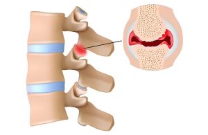 Viêm Khớp Liên Mấu Là Gì? Nguyên Nhân Và Cách Chữa Trị