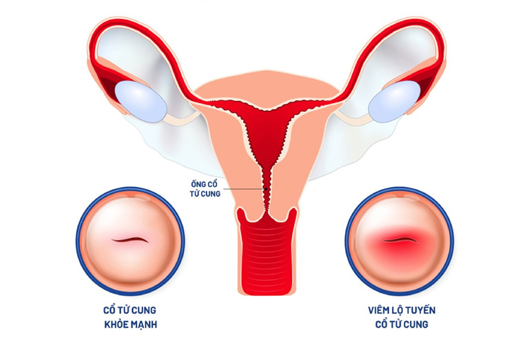 Viêm Lộ Tuyến Độ 2: Nguyên Nhân, Triệu Chứng, Cách Điều Trị