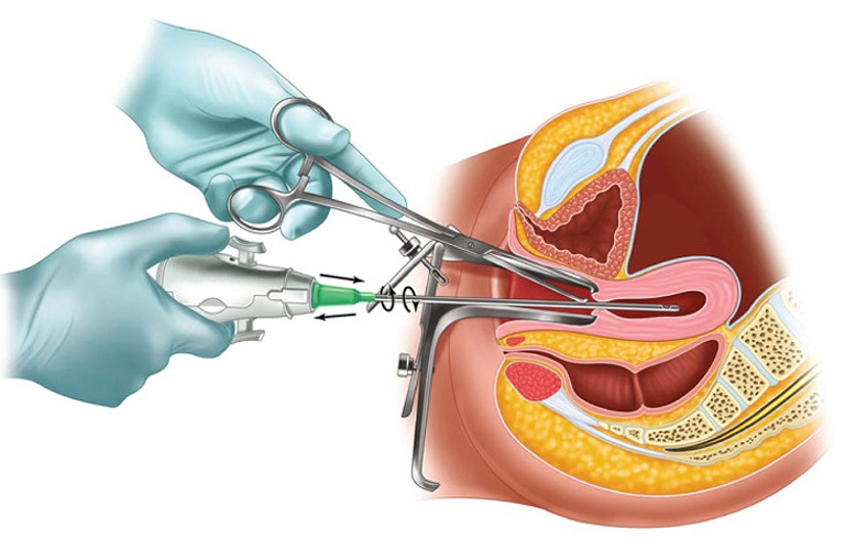 Can thiệp y khoa vùng kín làm tăng nguy cơ viêm phần phụ