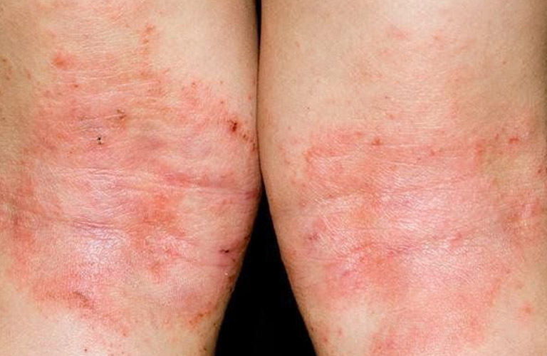 Có nhiều yếu tố gây khởi phát chàm dị ứng