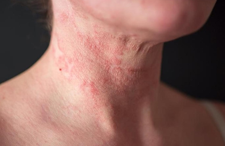 Chàm dị ứng là bệnh lý viêm da mãn tính