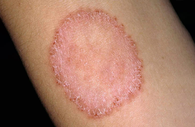 Bệnh hắc lào do nấm thuộc nhóm dermatophytes gây ra