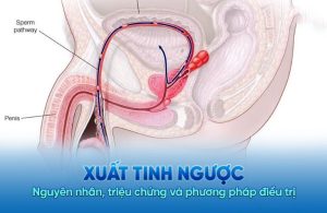 Xuất tinh ngược