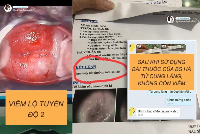 Kết quả sạch viêm lộ tuyến sau khi dùng thuốc